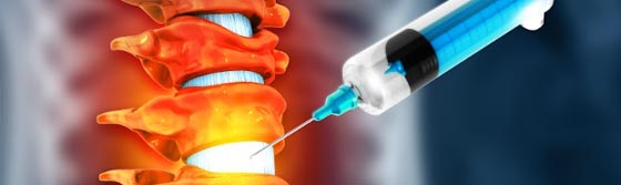 Injection Therapy for Spine Pain Management