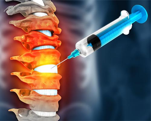 Injection Therapy for Spine Pain Management